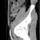 Chronic appendicitis, mimic of Crohn's disease, CT enterography: CT - Computed tomography